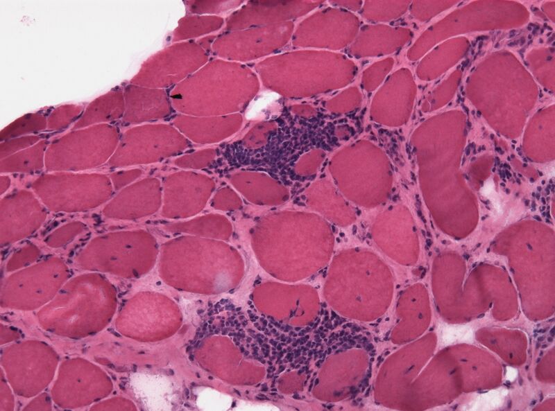 File:Polymyositis HE.jpg