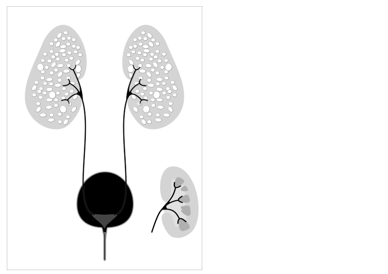 File:Autosomal recessive polycystic kidney disease.svg