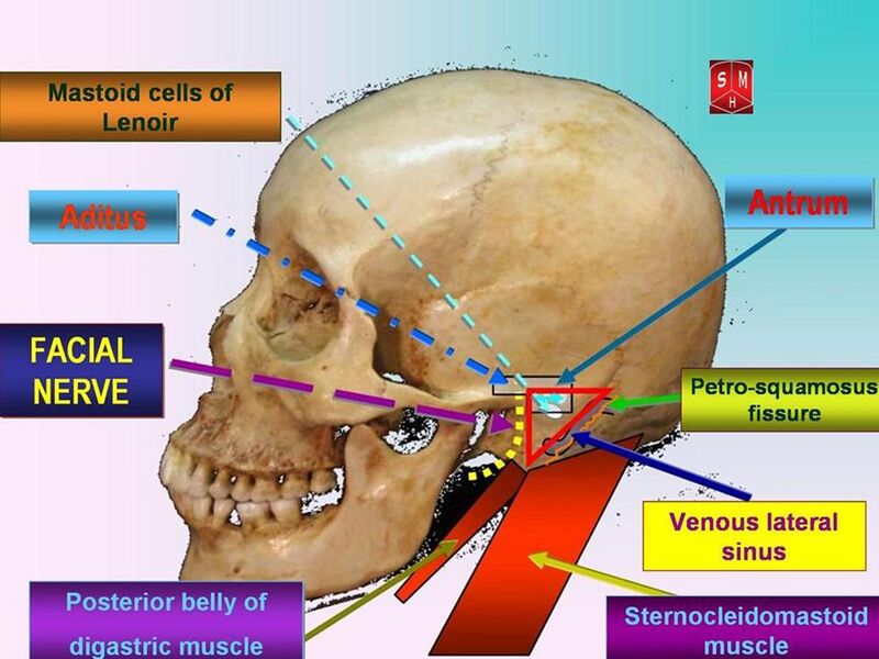 File:Attack triangle in mastoidectomies.jpg