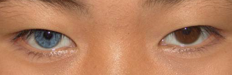 File:Heterochromia plos.png