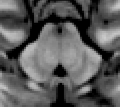 Periaqueductal gray on MRI