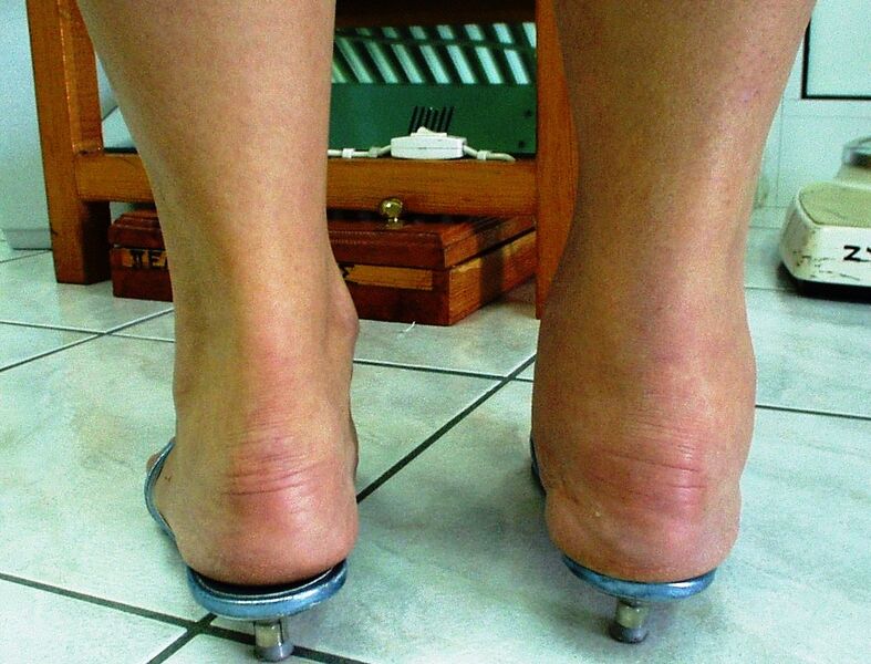File:Ankle Joint Arthritis.jpg