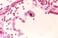 Cytomegalovirus inclusion
