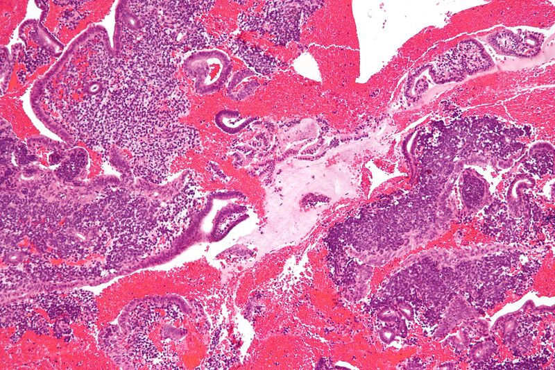 File:Endometrial stromal condensation high mag.jpg