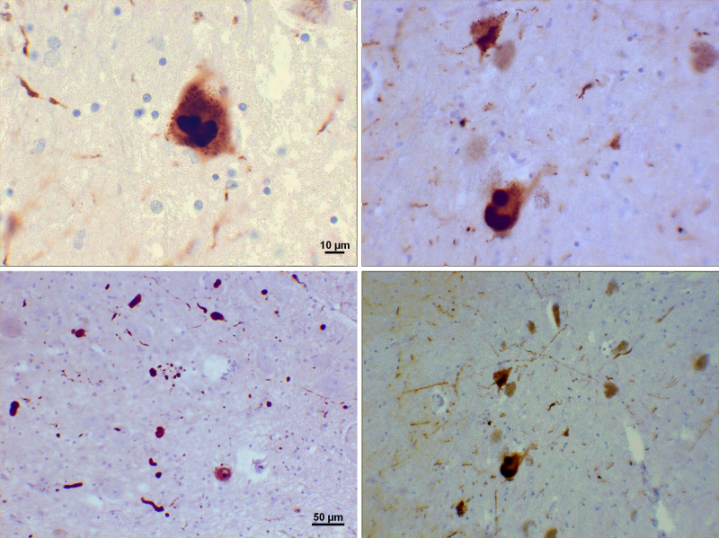 File:Lewy bodies (alpha synuclein inclusions).svg