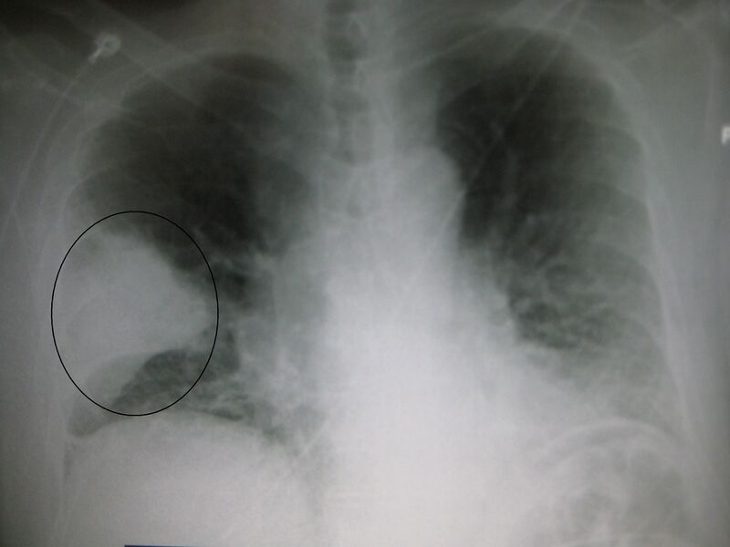 File:PneumonisWedge09.JPG