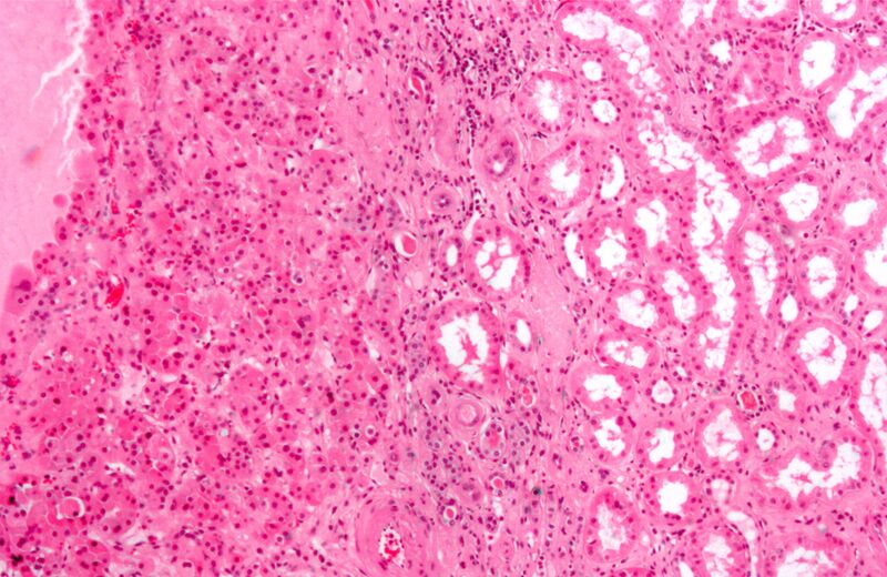 File:Renal oncocytoma2.jpg