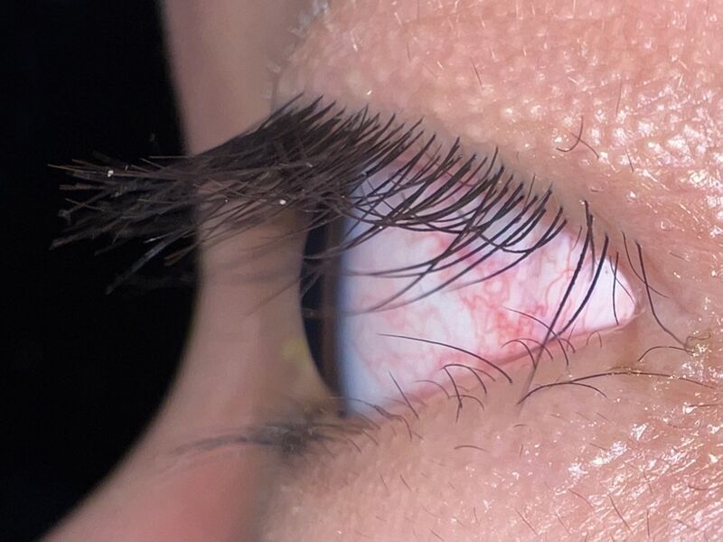 File:Human eye, lateral view.jpg