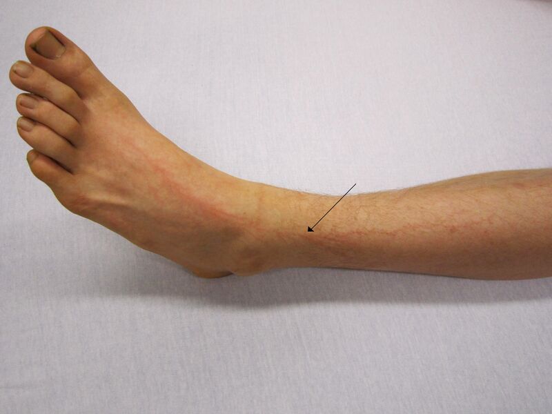 File:Lightning injury.jpg