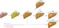 NAFLD liver progression
