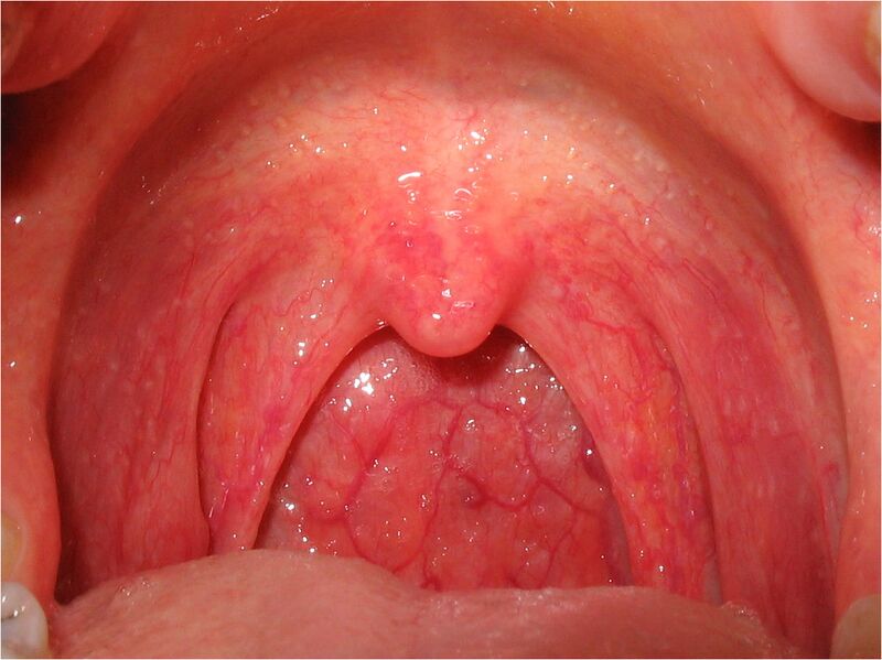 File:Pharyngitis.jpg