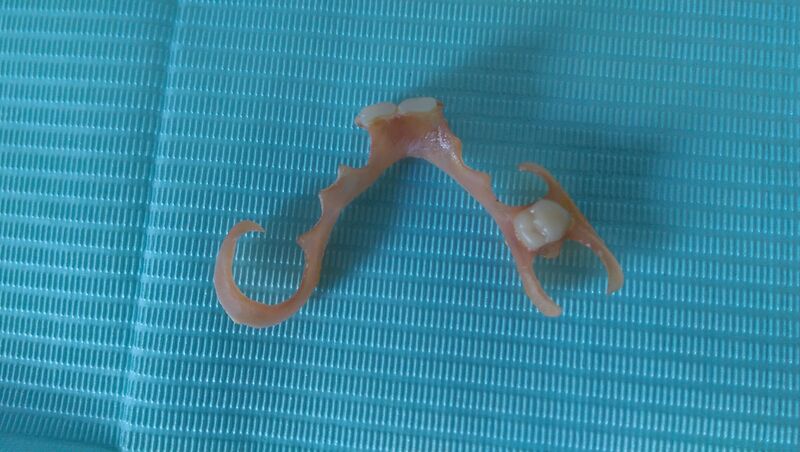File:Valplast removable partial denture.jpg