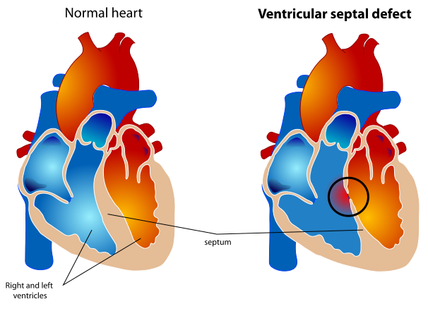File:Ventricular septal defect.svg