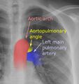 Medical illustration of the aortopulmonary angle.