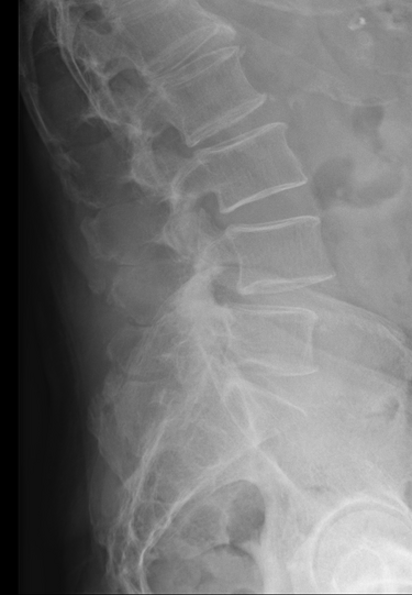 File:LumbarSpinalStenosis case1 X-ray.png