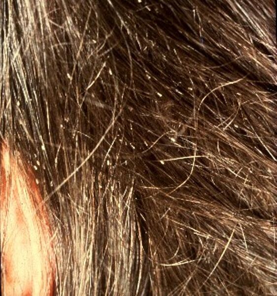 File:Fig. 5. Louse nits.jpg
