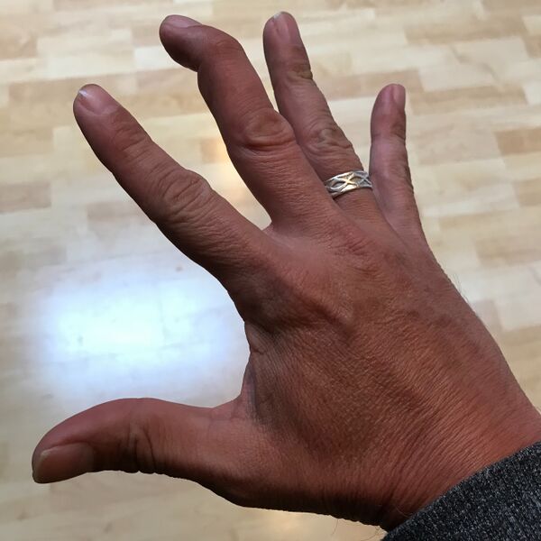 File:Mallet Finger Injury.jpg