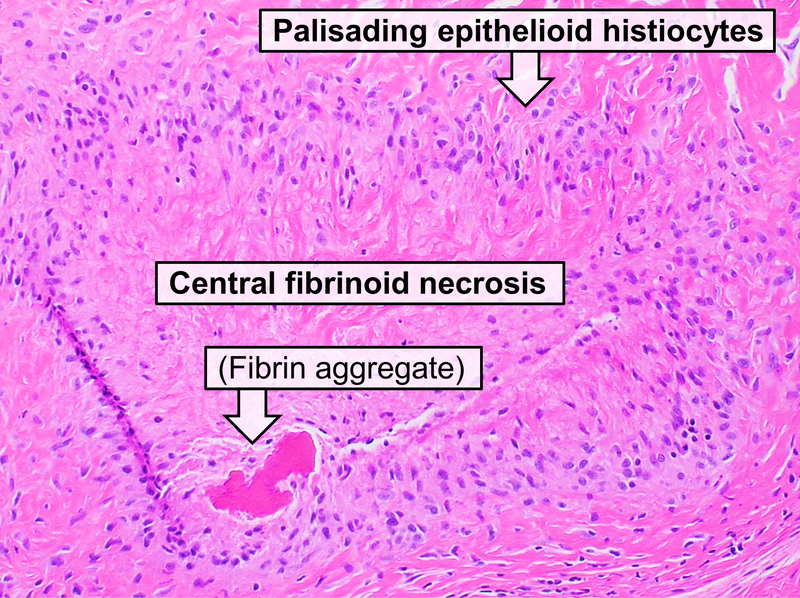 File:Histopathology of a rheumatoid nodule.png