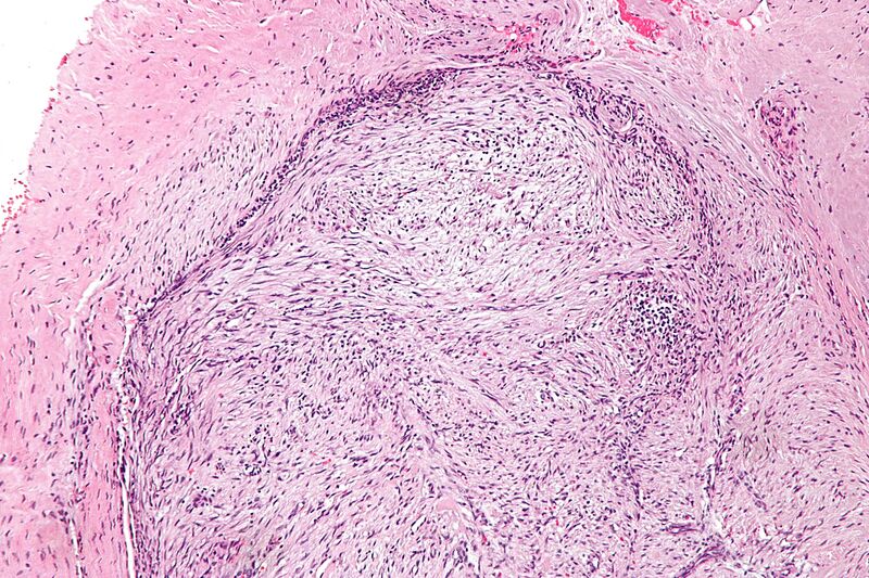 File:Nodular fasciitis - intermed mag.jpg