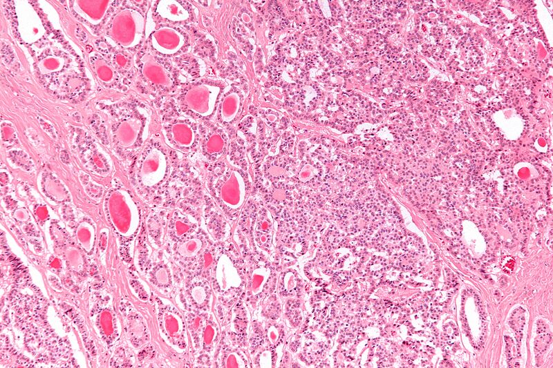 File:Strumal carcinoid - intermed mag.jpg