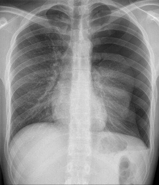 File:05-Spontanpneumothorax.jpg