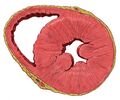 Heart left ventricular hypertrophy