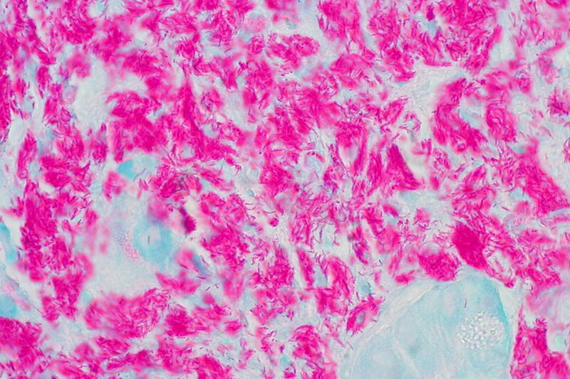 File:Mycobacterial Infection, Duodenum (4401445363).jpg