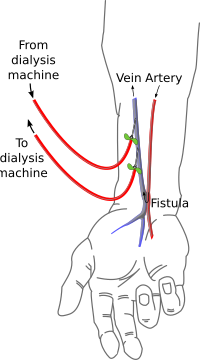 File:Radiocephalic fistula.svg