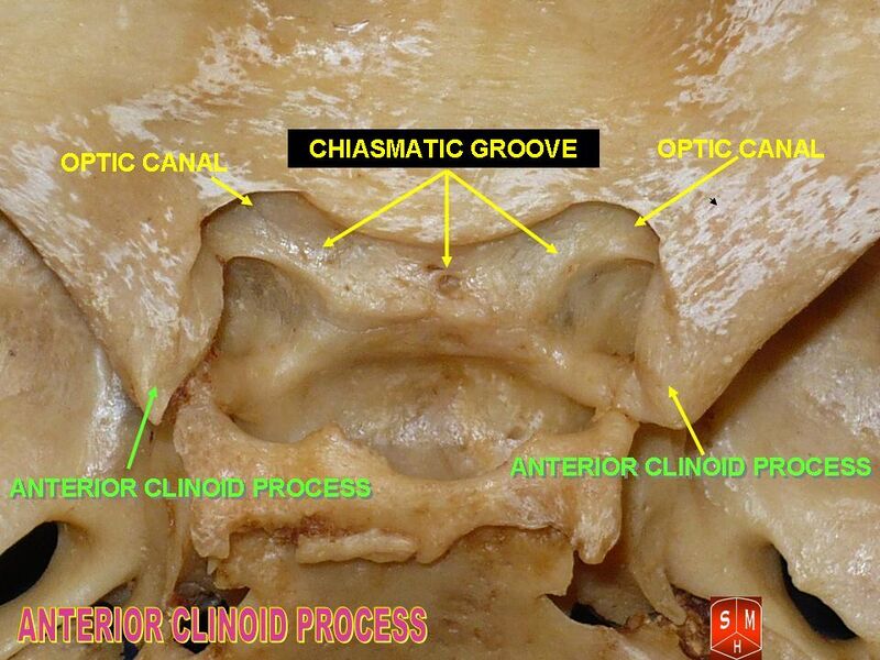 File:Anterior clinoid process.jpg