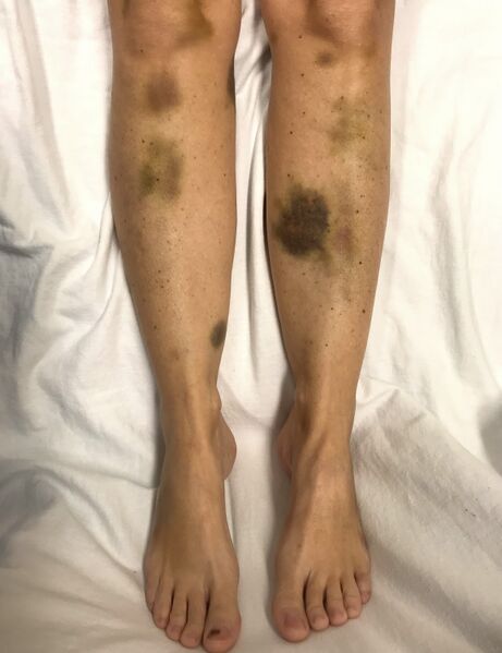 File:Echymosis.jpg