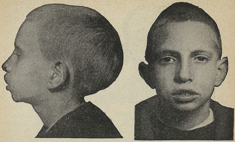 File:Dolichocéphalie a 10 ans.jpg