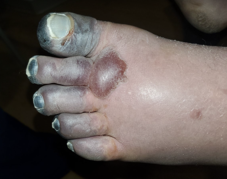 File:Left foot third degree frostbite.png