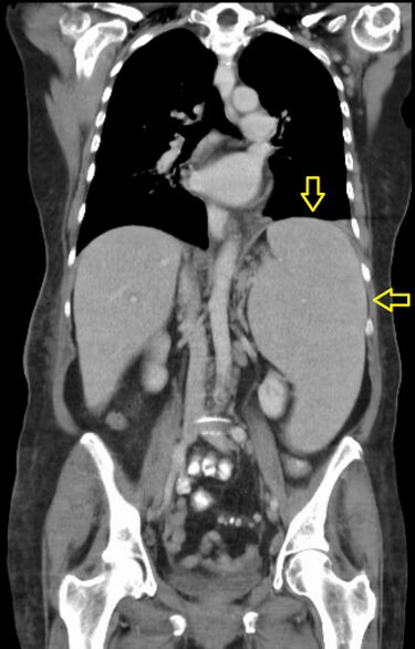 File:Splenomegalie bei CLL (labeled).jpg