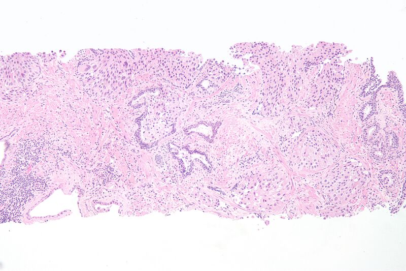 File:Urethral urothelial cell carcinoma.jpg