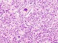 Aspiration pneumonia micrograph
