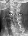 Intervertebral foramen