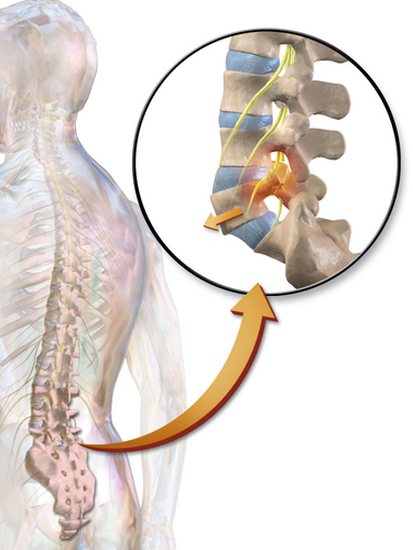 File:Spondylolisthesis.png