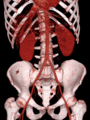 Volume rendered CT scan of abdominal and pelvic blood vessels