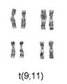 9;11 translocation