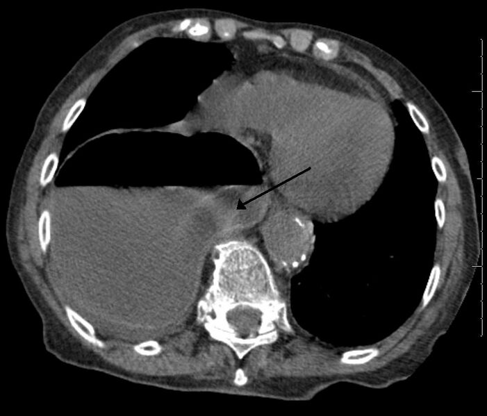 File:Diaphragm hernia2.jpg