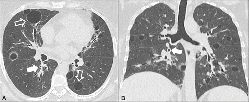 File:CT of lymphocytic interstitial pneumonia.jpg