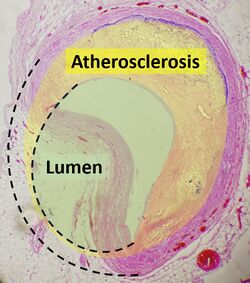 Atherosclerosis