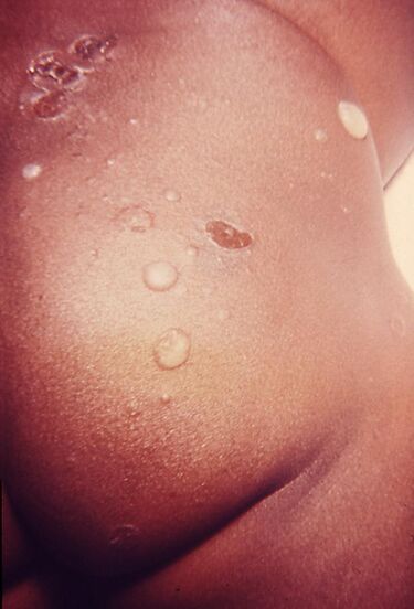 File:Impetigo.jpg