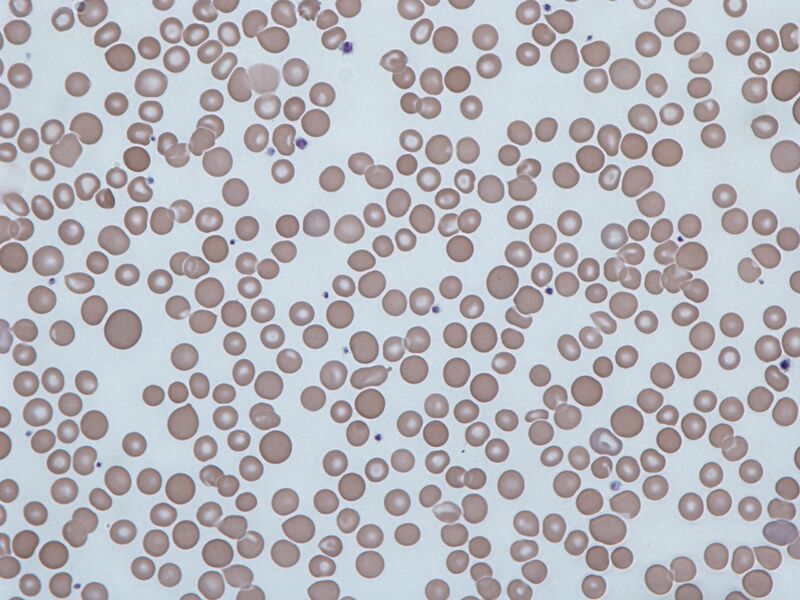 File:Anisocytosis.jpg