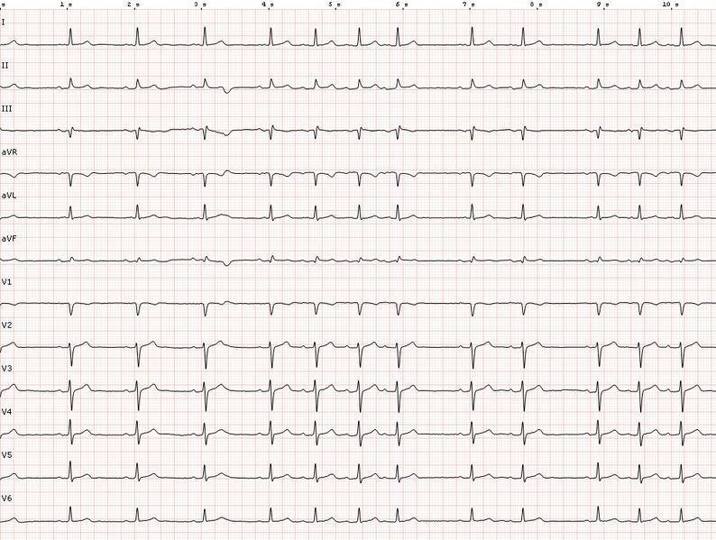 File:ECG sinus arrhythmia.jpg