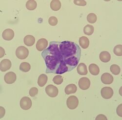 Flower cell in mantle cell lymphoma