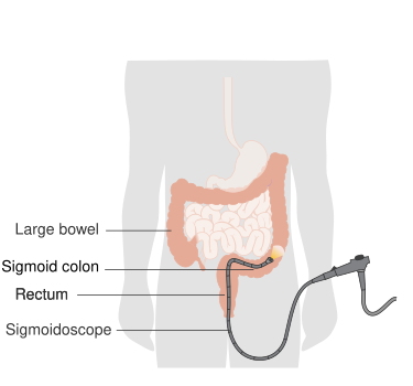 File:Diagram showing sigmoidoscopy.svg