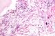 Pulmonary aspergillosis in lung tissue