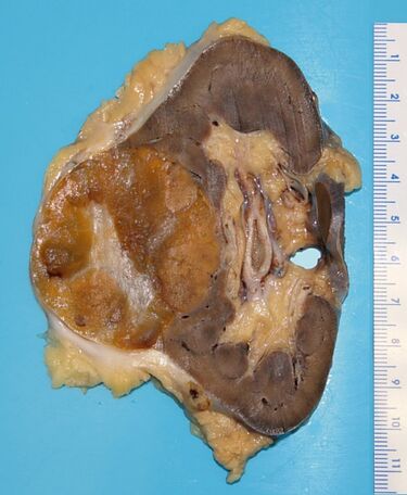 File:Renal oncocytoma.jpg