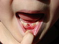Lost tooth